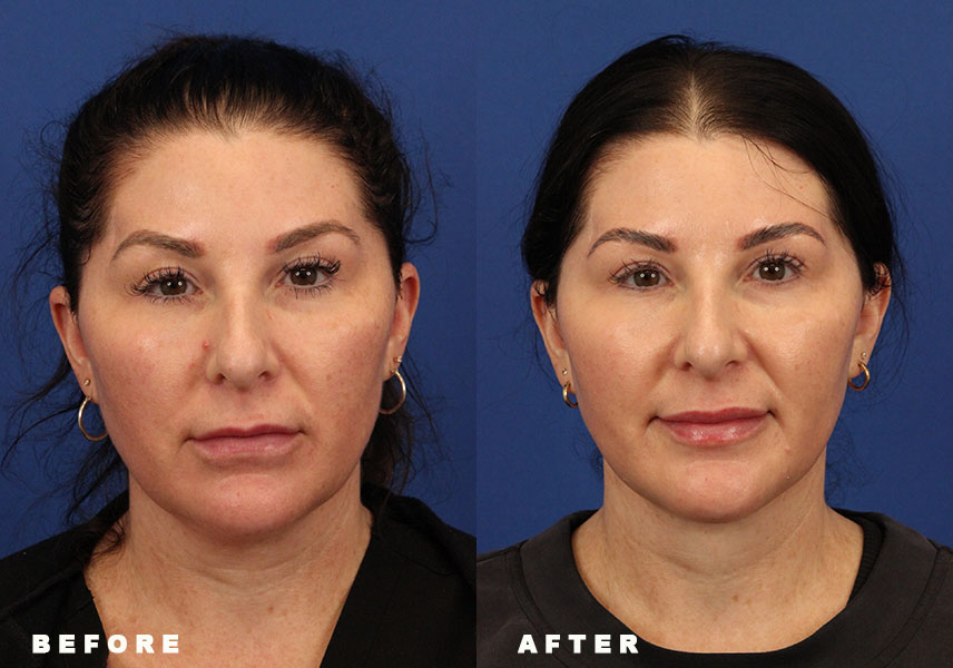 Photo of the patient’s Before & After the Deep Neck Lift. Patient 5 - Set 3