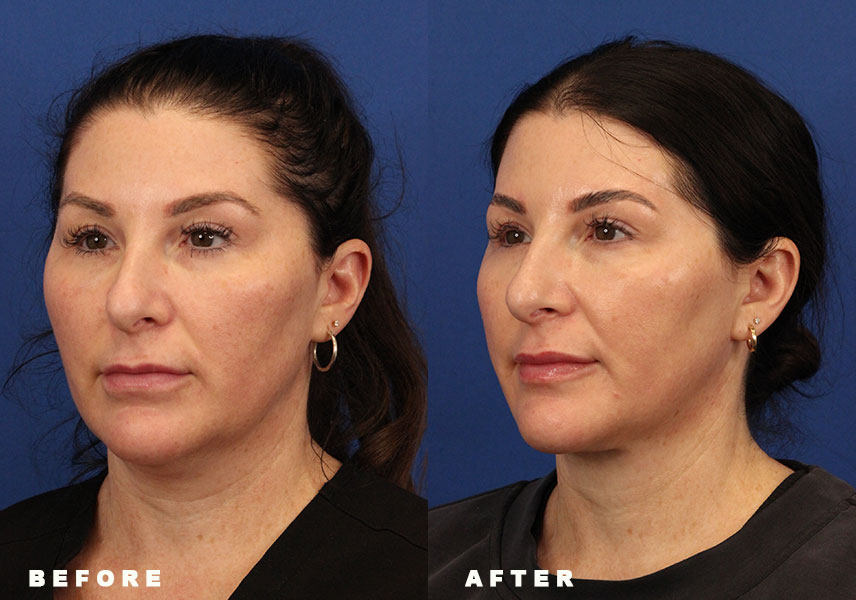 Photo of the patient’s Before & After the Deep Neck Lift Patient 5 - Set 4