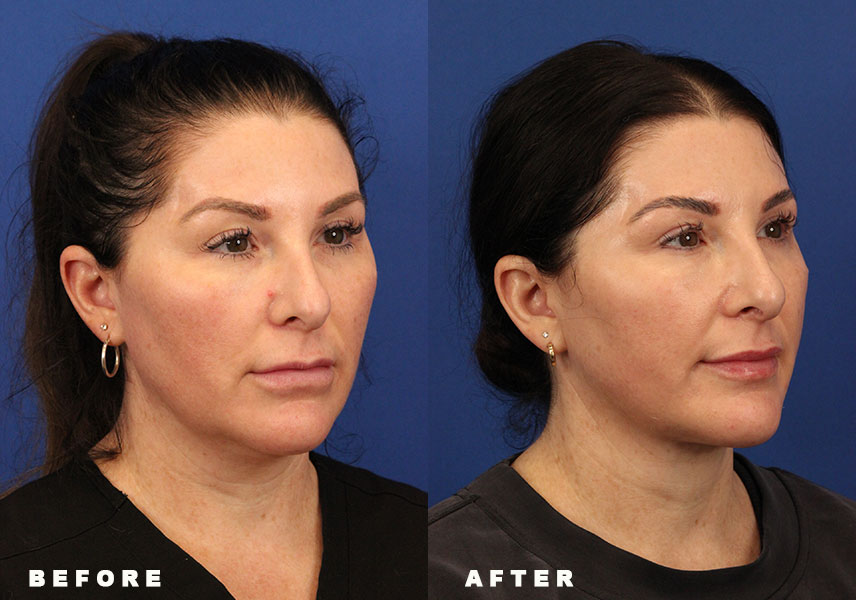 Photo of the patient’s Before & After the Deep Neck Lift. Patient 5 - Set 1