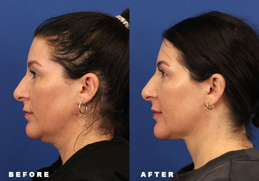 Photo of the patient’s Before & After the Deep Neck Lift Patient 5 - Set 5