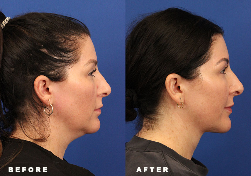 Photo of the patient’s Before & After the Deep Neck Lift. Patient 5 - Set 2