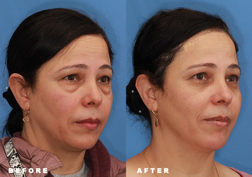 Photo of the patient’s Before & After the Eyelid Surgery. Patient 3 - Set 2