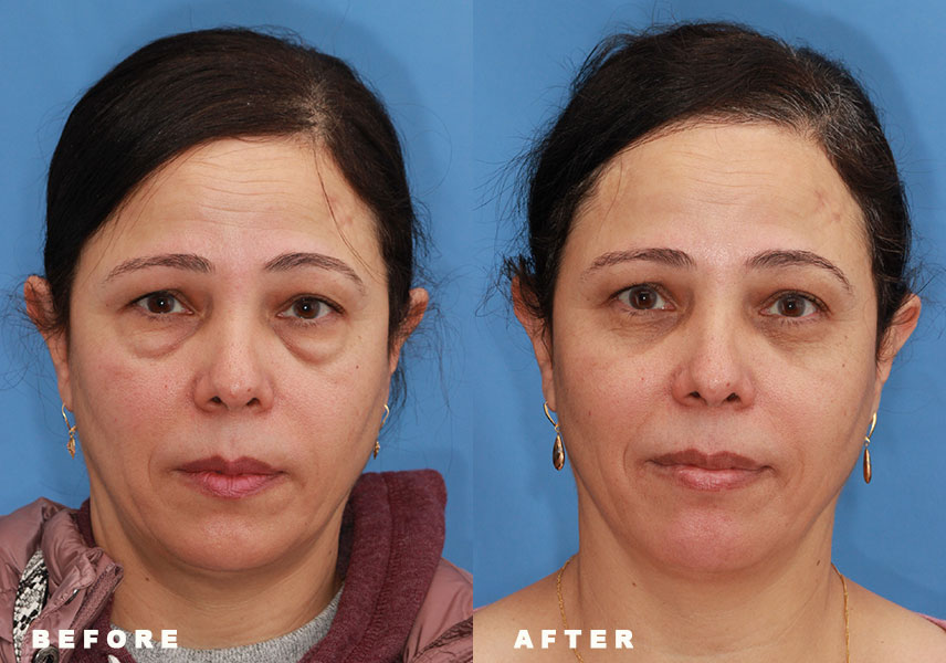 Photo of the patient’s Before & After the Eyelid Surgery. Patient 3 - Set 1