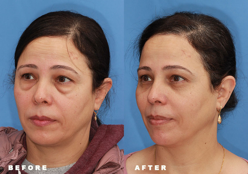 Photo of the patient’s Before & After the Eyelid Surgery. Patient 3 - Set 3