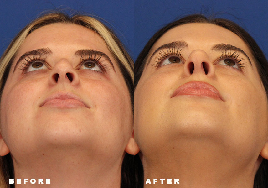 Photo of the patient’s Before & After the Rhinoplasty Patient 8 - Set 6