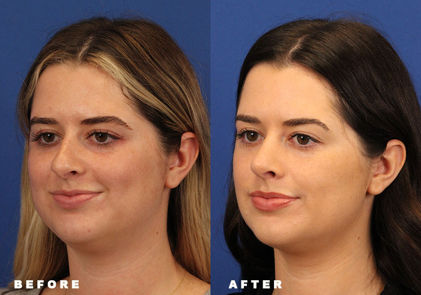 Photo of the patient’s Before & After the Rhinoplasty Patient 8 - Set 4