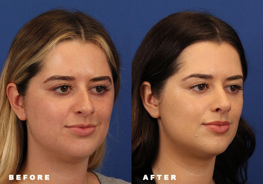 Patient 8 - Bapna Facial Plastic Surgery