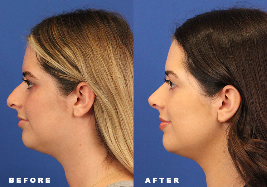 Photo of the patient’s Before & After the Rhinoplasty Patient 8 - Set 5