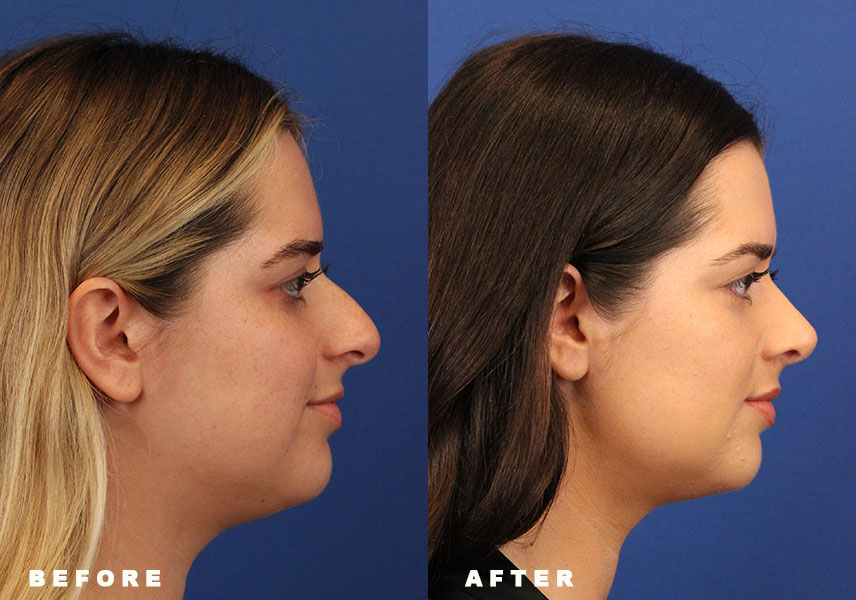 Photo of the patient’s Before & After the Rhinoplasty Patient 8 - Set 3