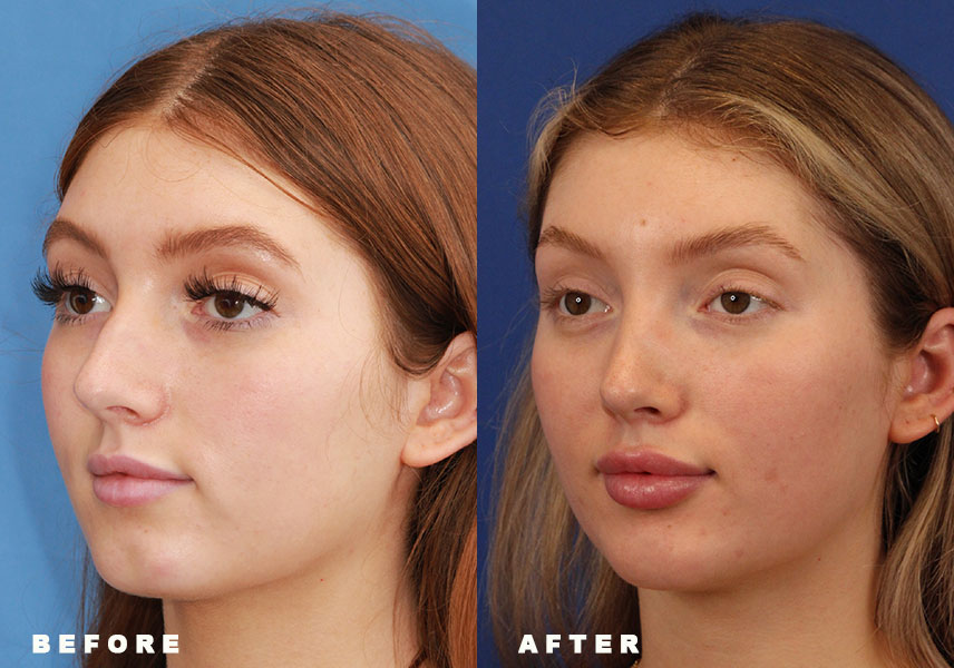 Photo of the patient’s Before & After the Rhinoplasty Patient 9 - Set 4