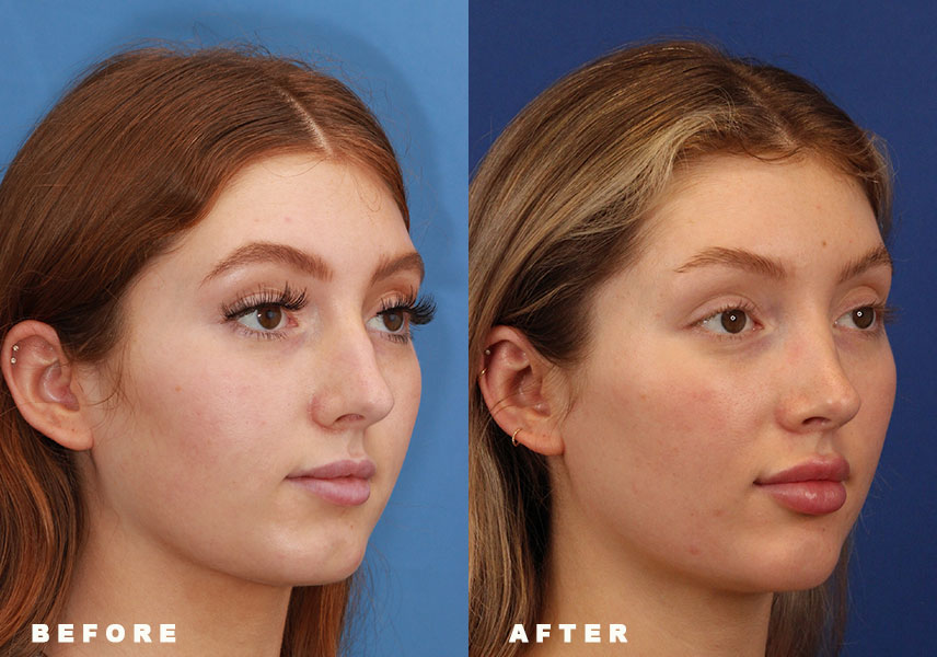 Photo of the patient’s Before & After the Rhinoplasty Patient 9 - Set 2