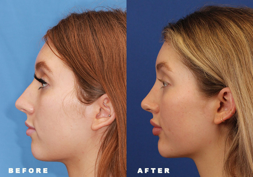 Photo of the patient’s Before & After the Rhinoplasty Patient 9 - Set 5