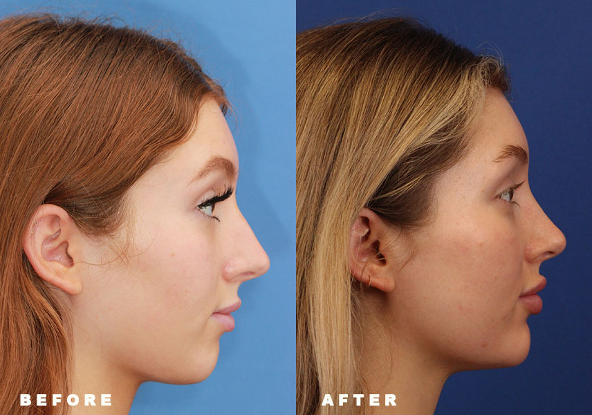 Photo of the patient’s Before & After the Rhinoplasty Patient 9 - Set 3