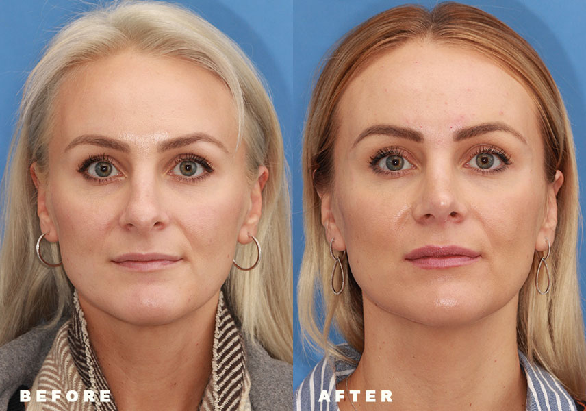 Photo of the patient’s Before & After the Rhinoplasty Revision. Patient 2 - Set 1