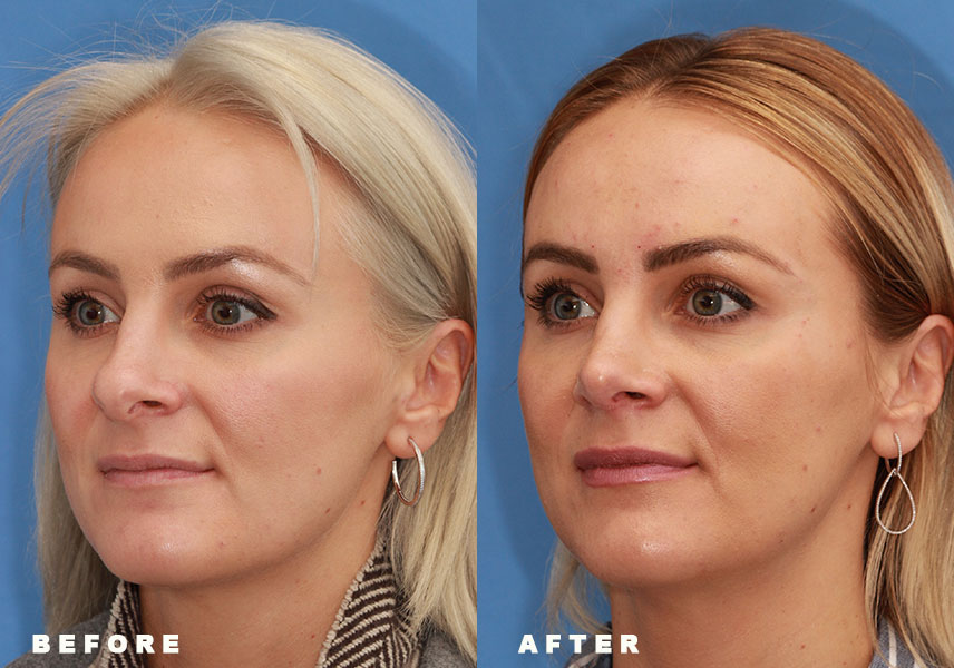 Photo of the patient’s Before & After the Rhinoplasty Revision Patient 2 - Set 5