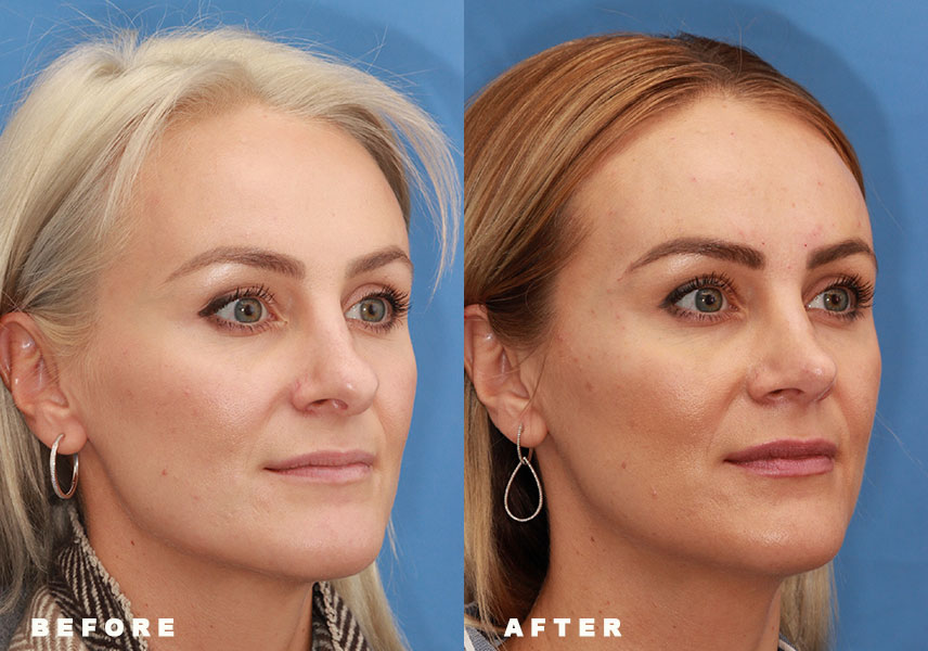 Photo of the patient’s Before & After the Rhinoplasty Revision Patient 2 - Set 4