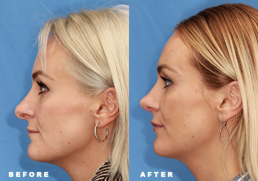 Photo of the patient’s Before & After the Rhinoplasty Revision. Patient 2 - Set 3