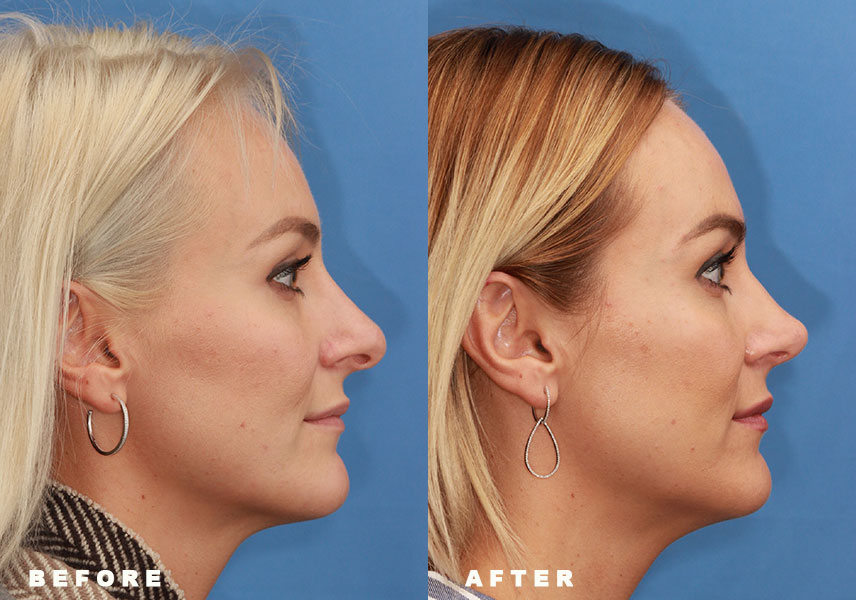 Photo of the patient’s Before & After the Rhinoplasty Revision. Patient 2 - Set 2